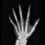 x-ray of a hand