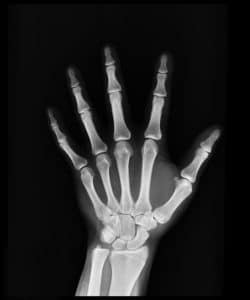 x-ray of a hand 